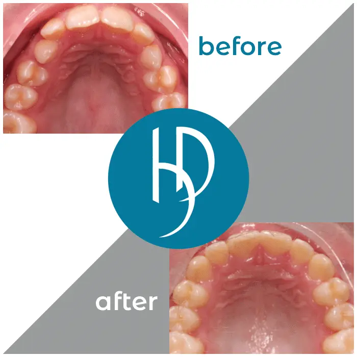 HD-Ortho-HD-before-after1