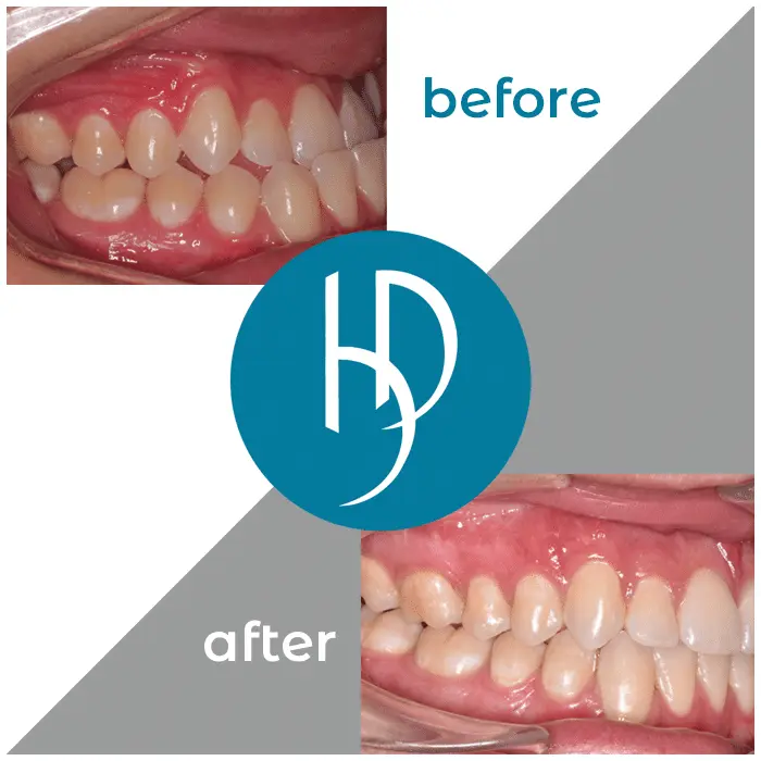 HD-Ortho-HD-before-after10