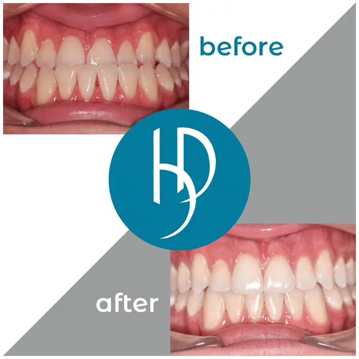 HD-Ortho-HD-before-after11