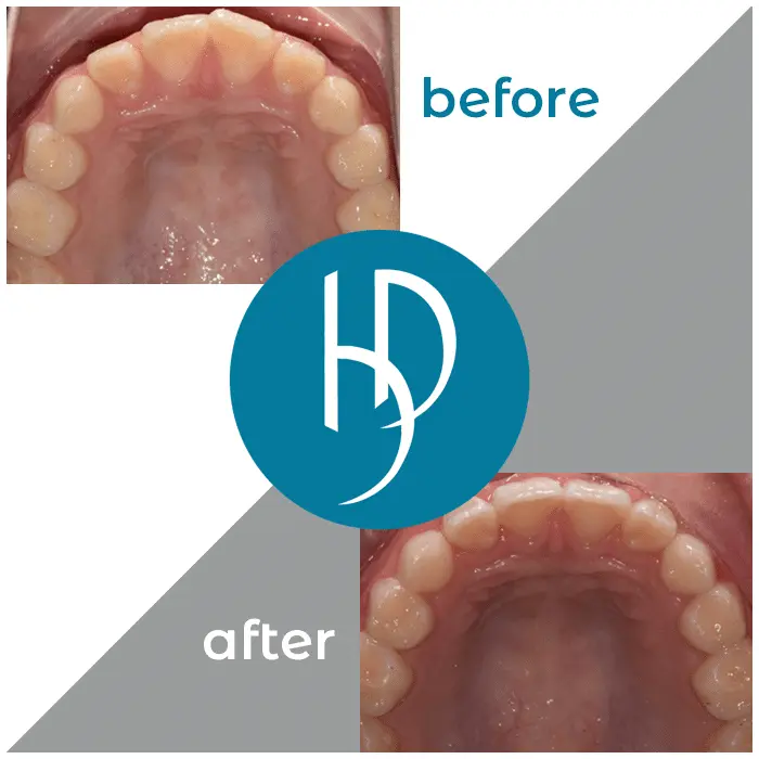 HD-Ortho-HD-before-after12
