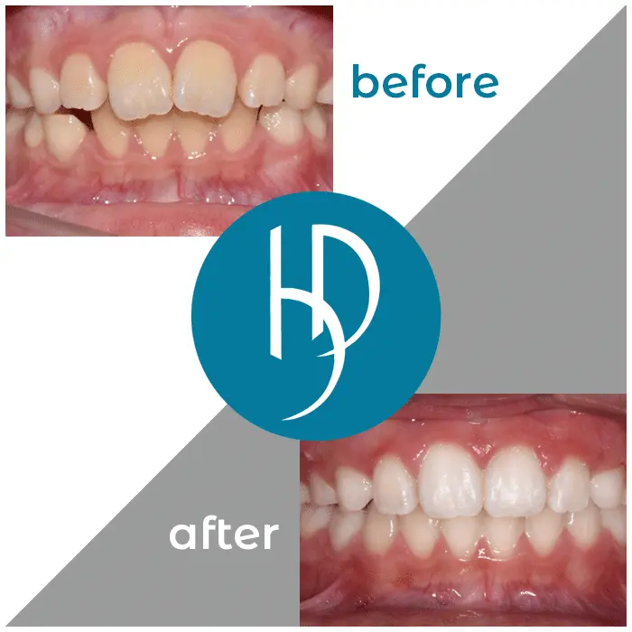 HD-Ortho-HD-before-after13
