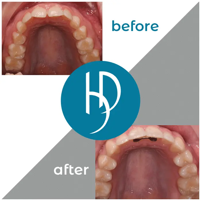 HD-Ortho-HD-before-after14