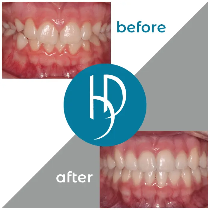 HD-Ortho-HD-before-after15