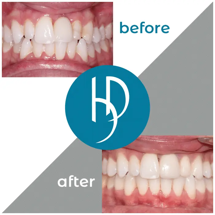 HD-Ortho-HD-before-after16
