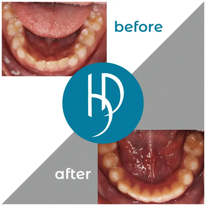 HD-Ortho-HD-before-after17