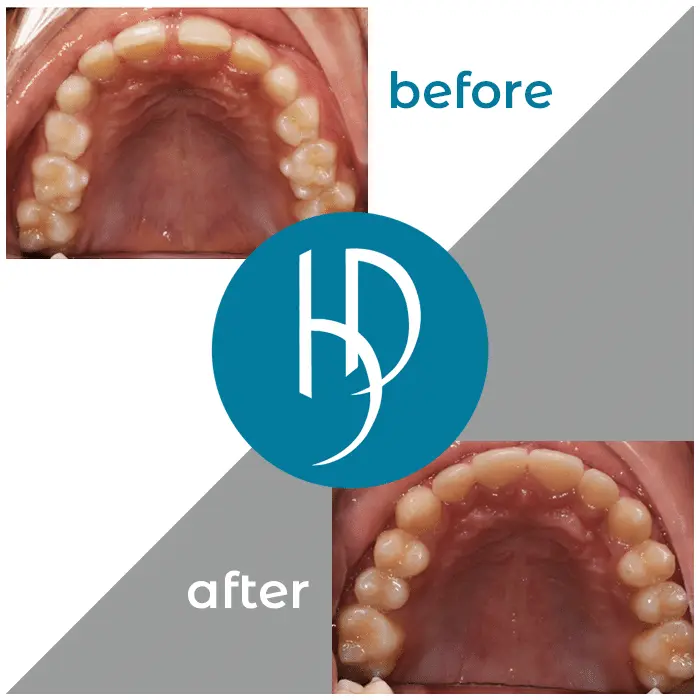 HD-Ortho-HD-before-after18