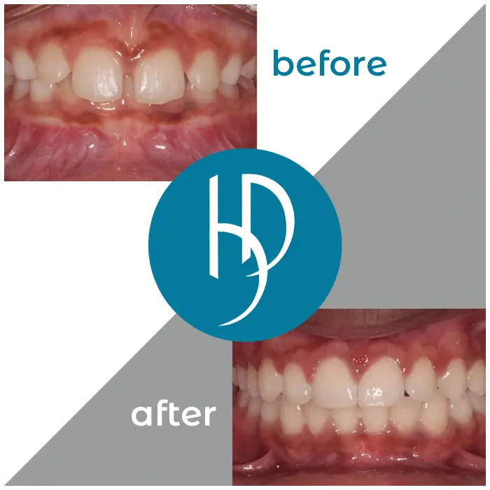 HD-Ortho-HD-before-after19