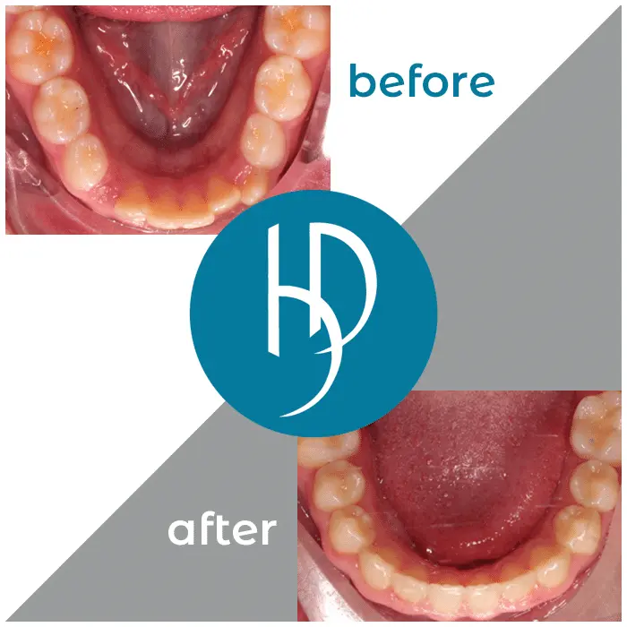 HD-Ortho-HD-before-after2