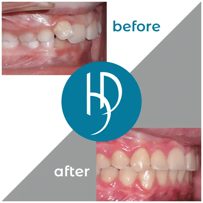 HD-Ortho-HD-before-after20