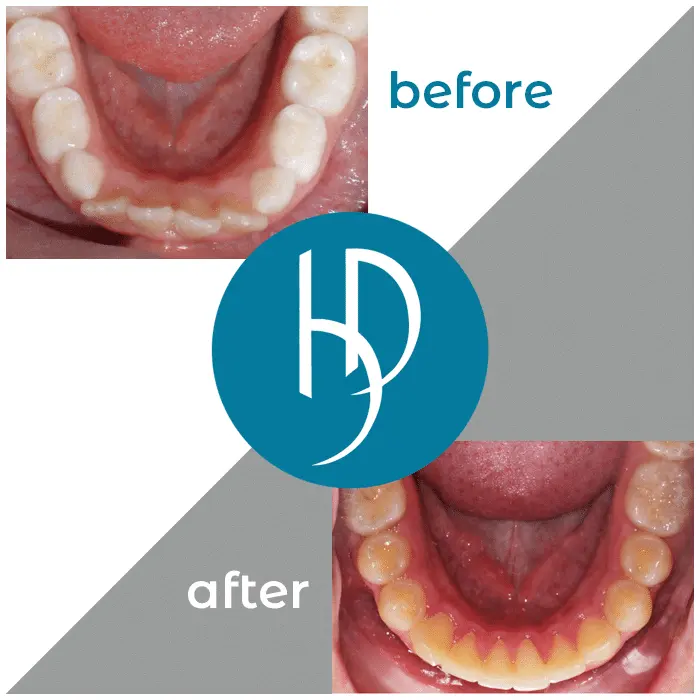 HD-Ortho-HD-before-after21