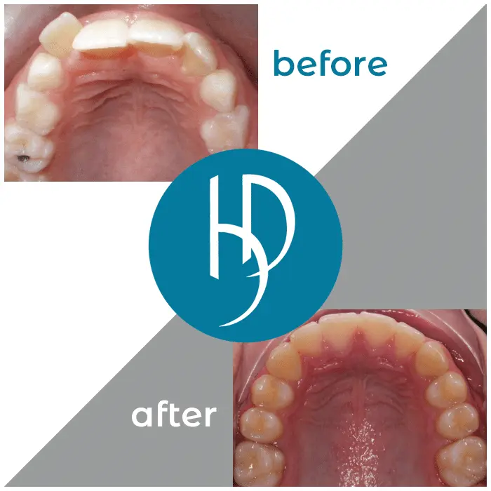 HD-Ortho-HD-before-after22