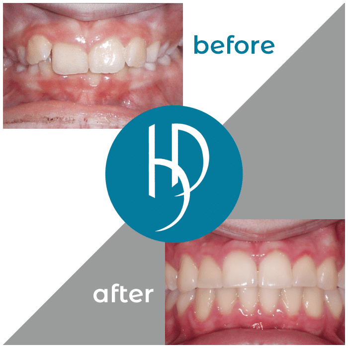 HD-Ortho-HD-before-after23