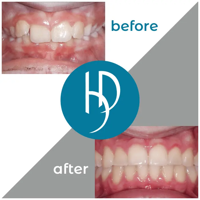 HD-Ortho-HD-before-after23