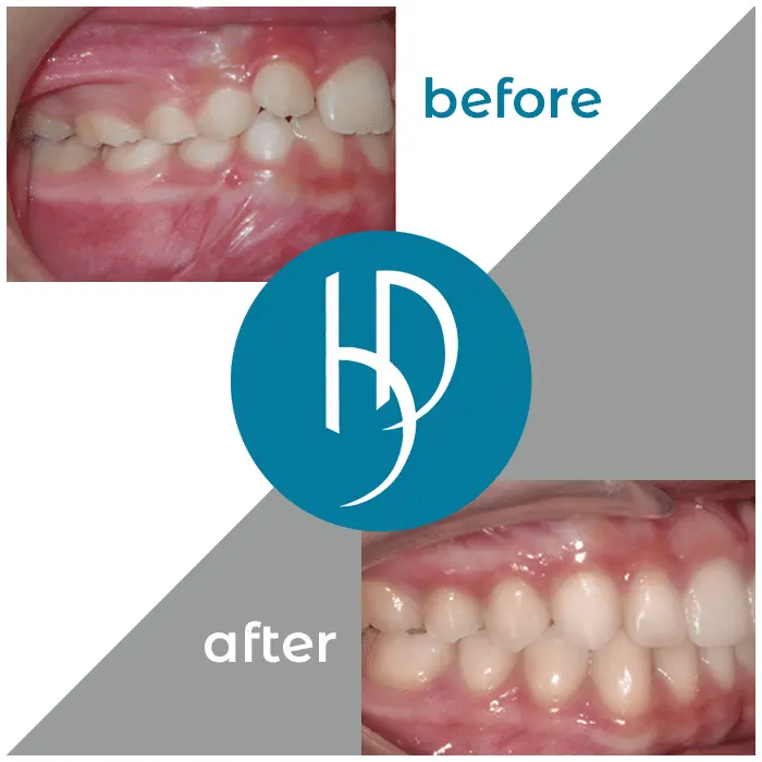 HD-Ortho-HD-before-after24