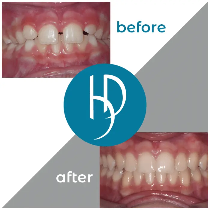 HD-Ortho-HD-before-after25
