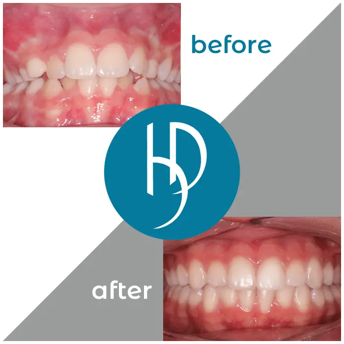 HD-Ortho-HD-before-after26