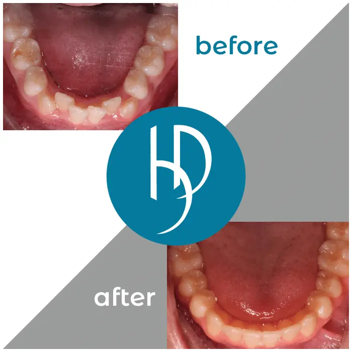 HD-Ortho-HD-before-after27