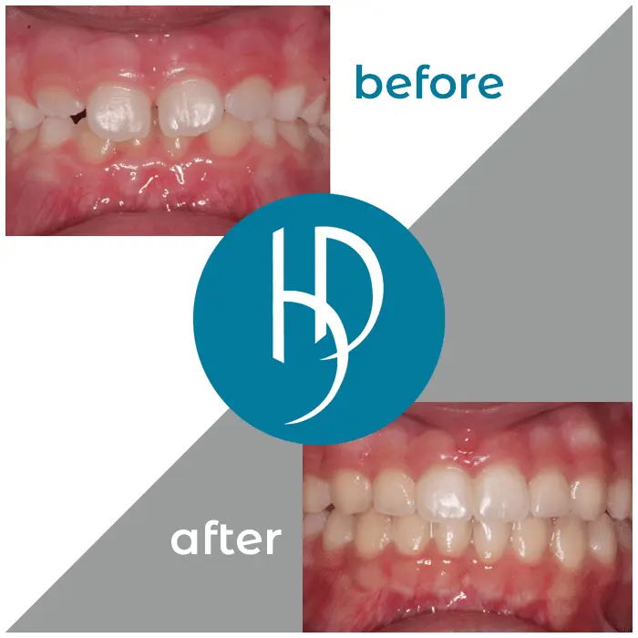 HD-Ortho-HD-before-after28