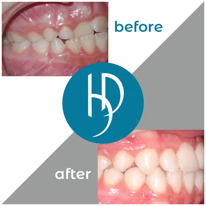 HD-Ortho-HD-before-after29