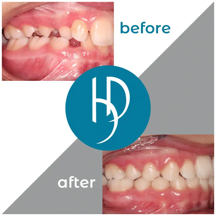 HD-Ortho-HD-before-after3