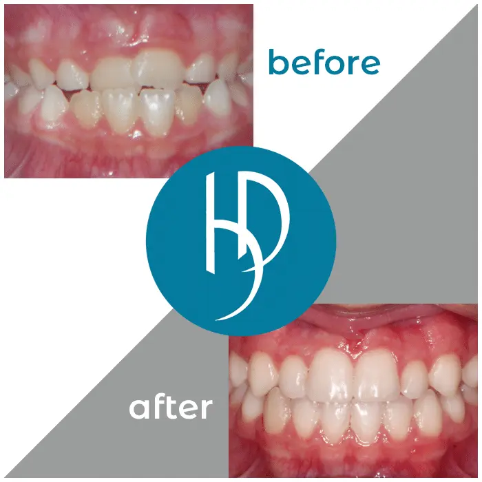 HD-Ortho-HD-before-after30