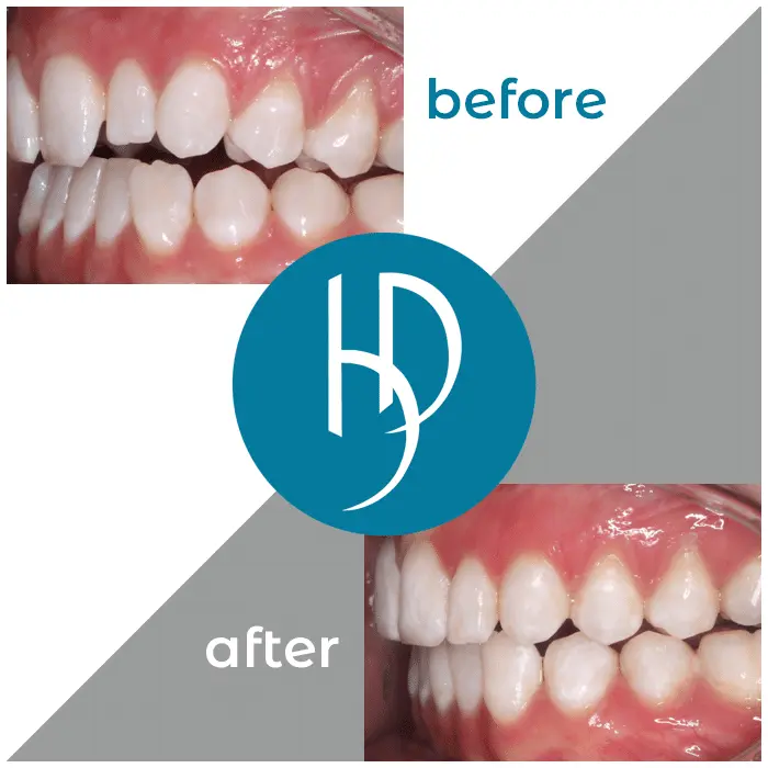 HD-Ortho-HD-before-after31