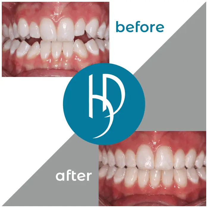 HD-Ortho-HD-before-after32