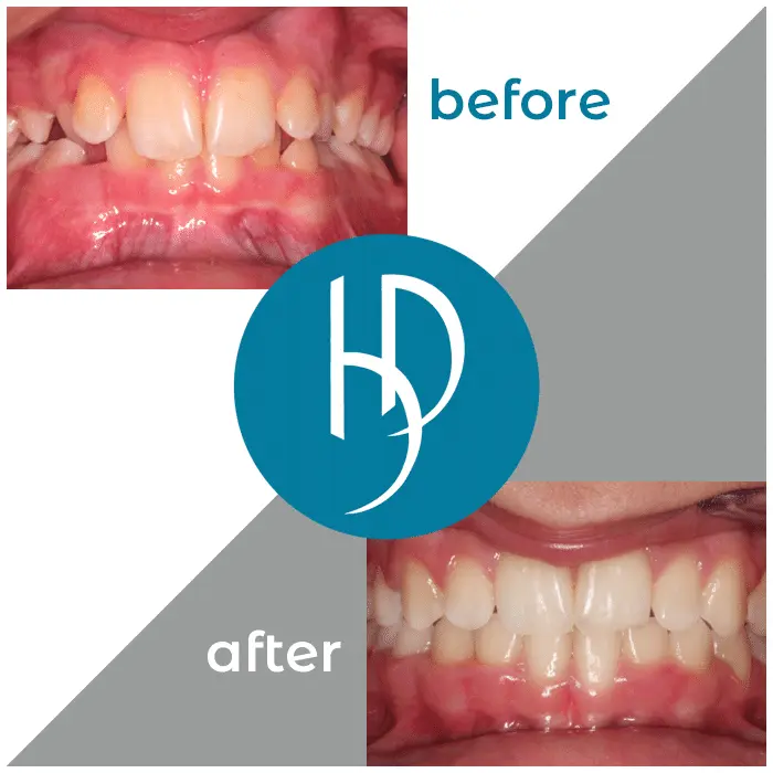 HD-Ortho-HD-before-after4