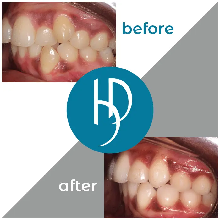 HD-Ortho-HD-before-after5