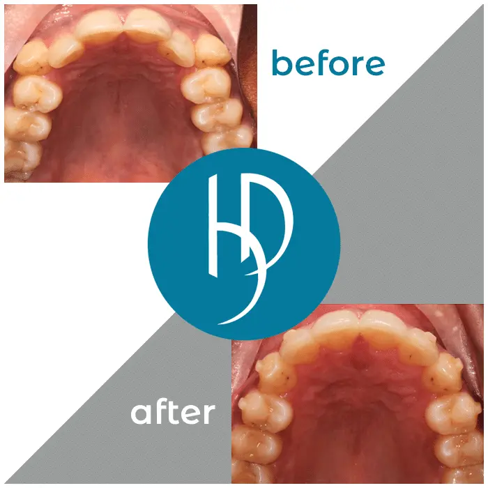 HD-Ortho-HD-before-after6