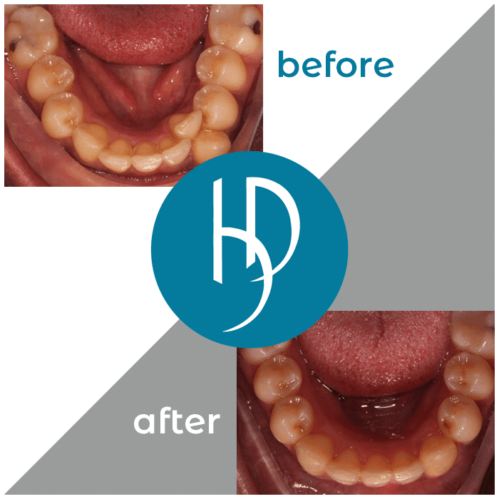 HD-Ortho-HD-before-after7