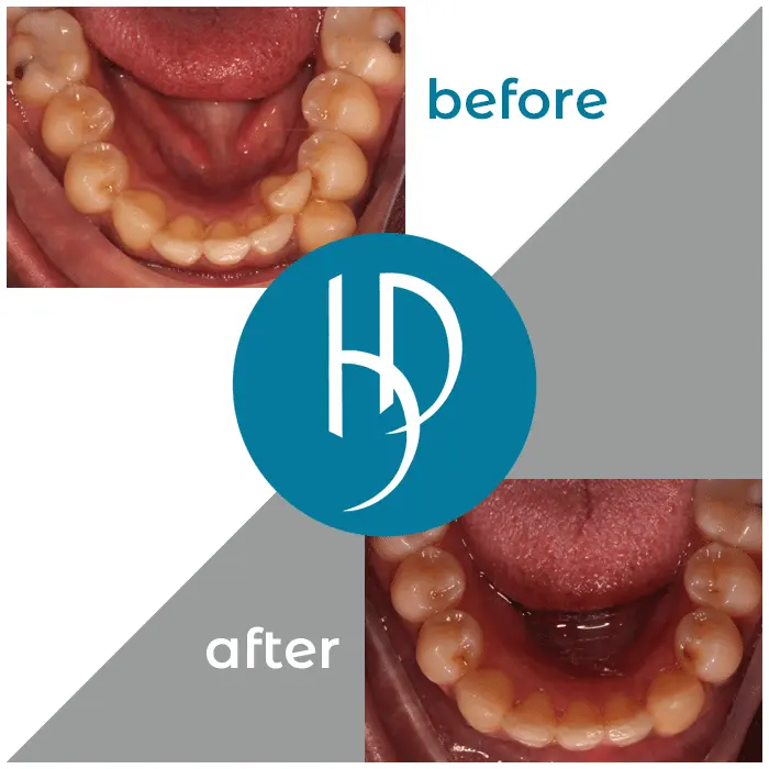 HD-Ortho-HD-before-after7