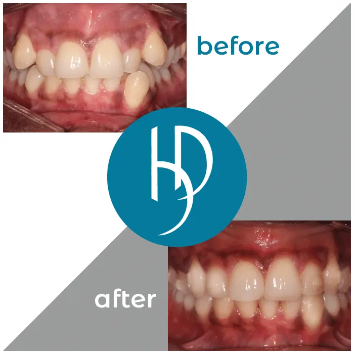 HD-Ortho-HD-before-after8