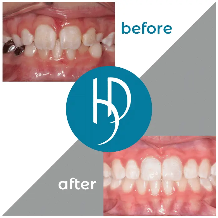 HD-Ortho-HD-before-after9