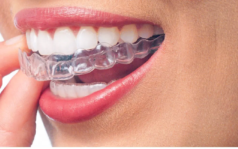 HD-Ortho-invisalign-09