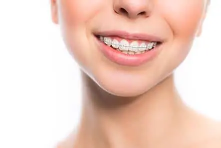 HD-Ortho-ceramic-braces