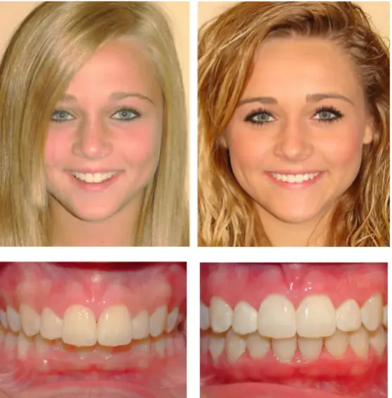 HD-Ortho-invisalign-img1