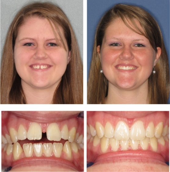 invisalign ortho harrisburg veneers