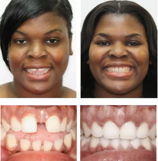 HD-Ortho-invisalign-img3