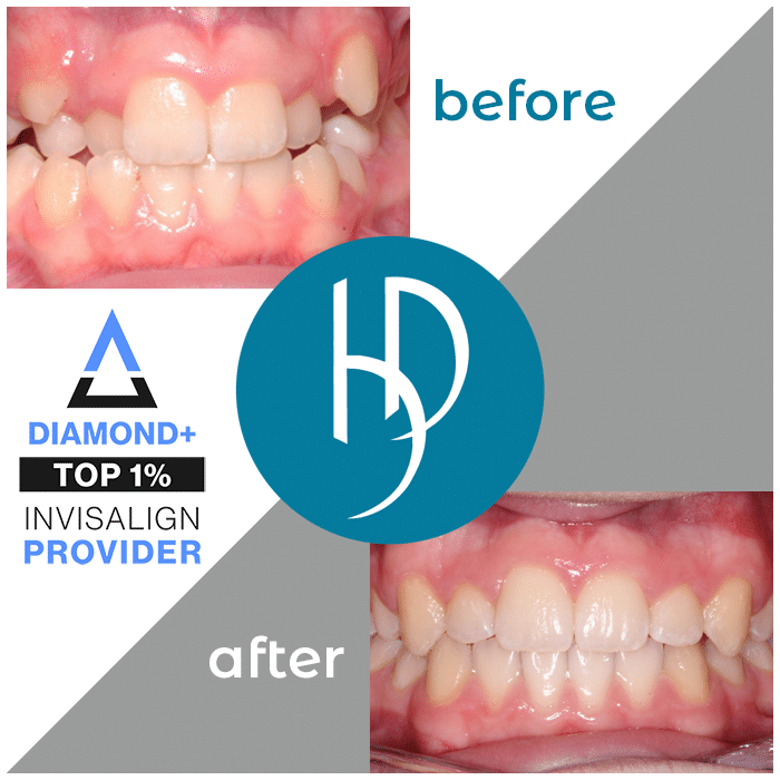 crossbite treatment harrisburg pa