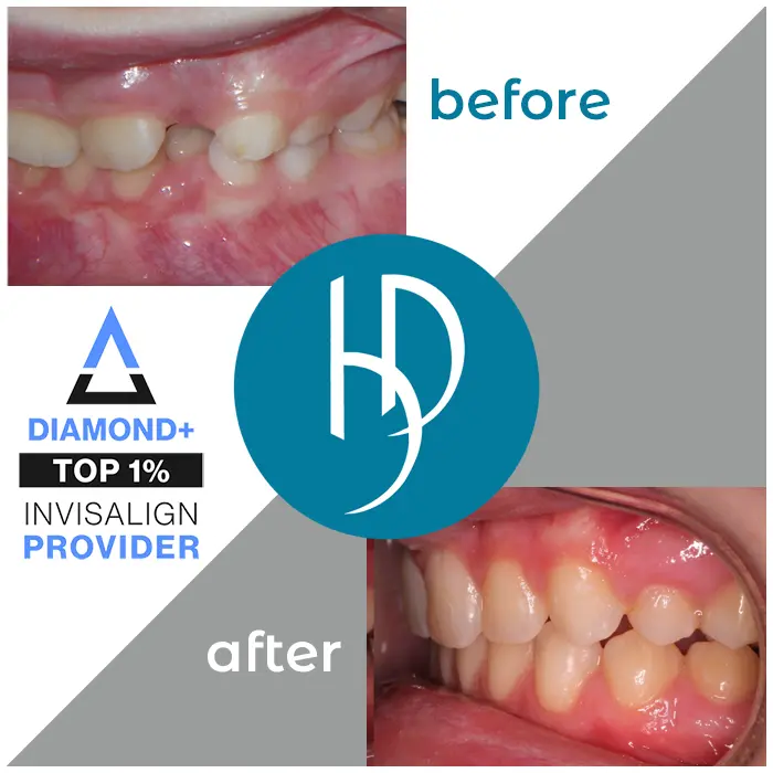 HD-Ortho-orthodontic-treatment-kids-harrisburg-pa