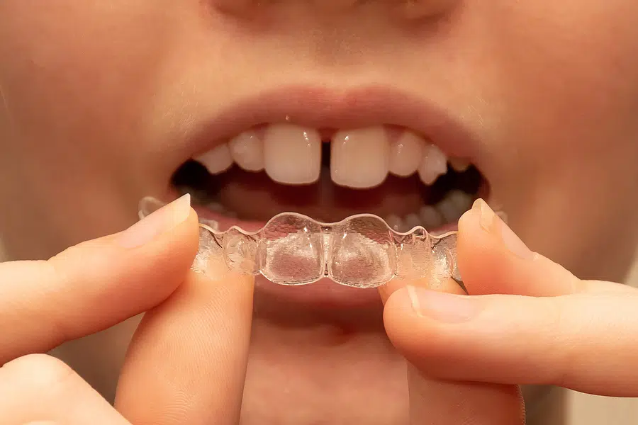 Orthodontics for adults with Invisalign