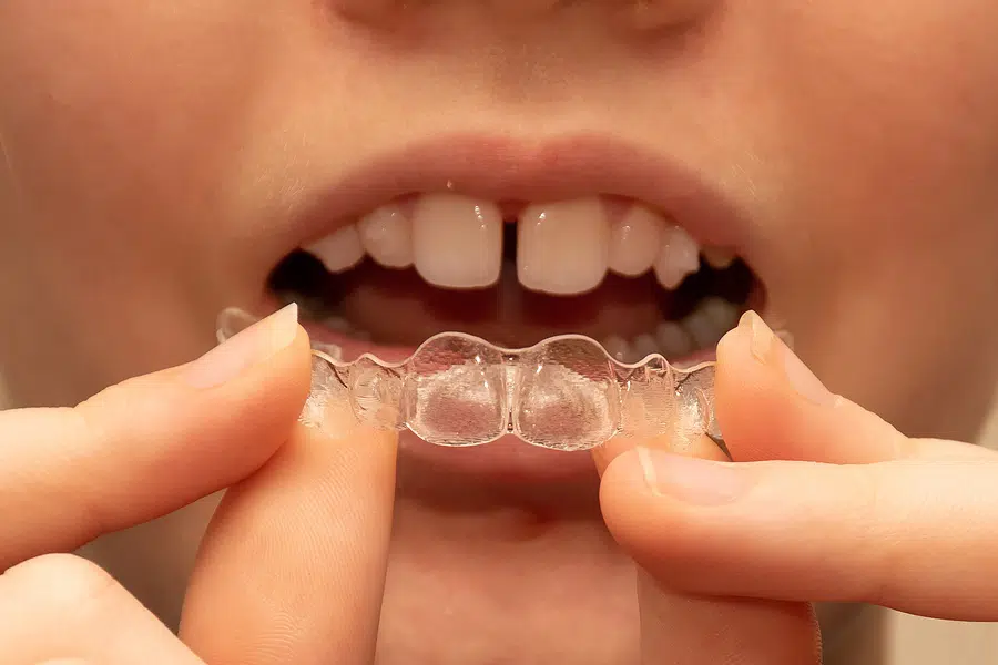 Invisalign Teen, Innovative Orthodontic Centers