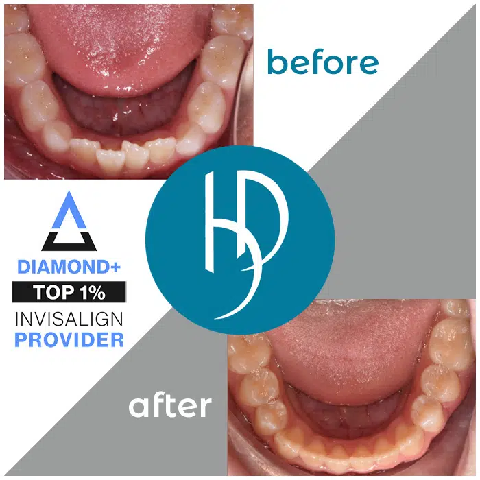 HD-Ortho-crooked-teeth-treatment-camp-hill-pa