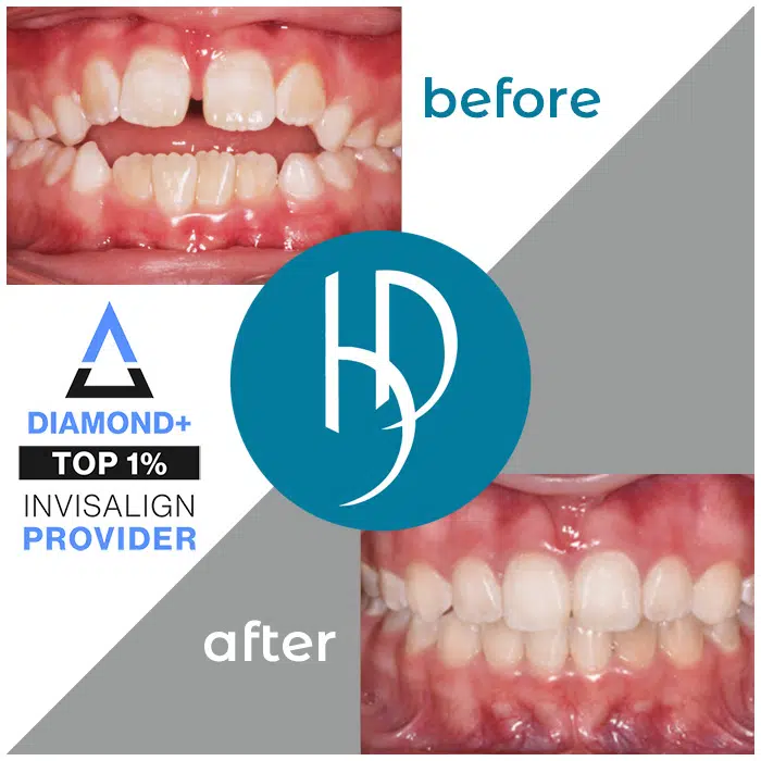 HD-Ortho-crooked-teeth-treatment-carlisle-pa
