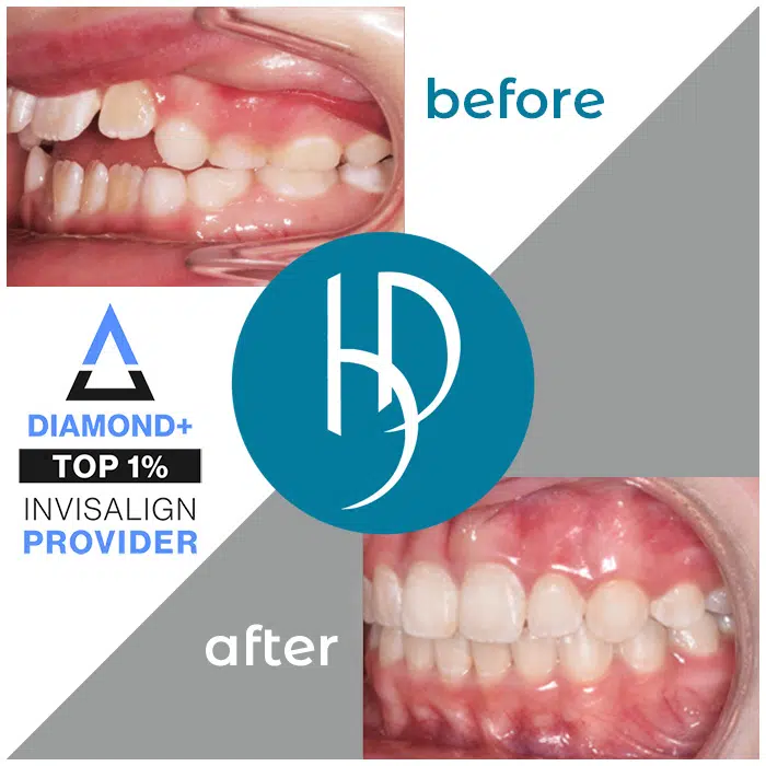 HD-Ortho-crooked-teeth-treatment-dauphin-county-pa