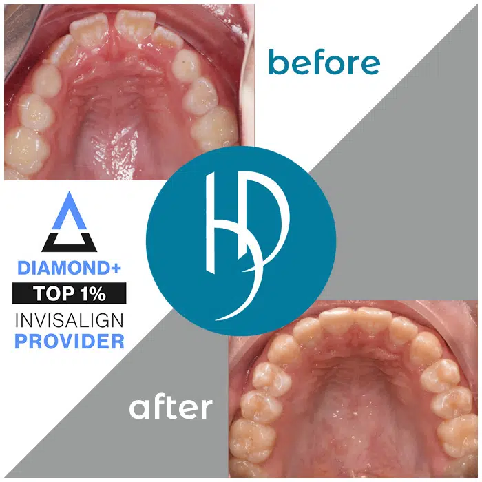 HD-Ortho-crooked-teeth-treatment-harrisburg-pa