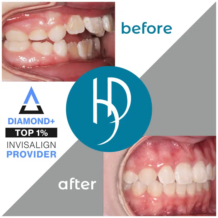 HD-Ortho-crooked-teeth-treatment-mechanicsburg-pa
