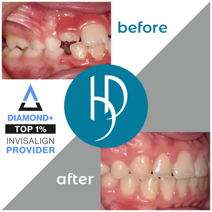 HD-Ortho-crossbite-treatment-camp-hill-pa