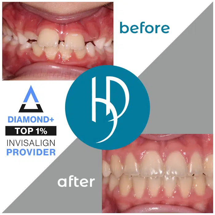 HD-Ortho-crossbite-treatment-carlisle-pa